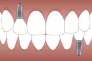 dental implant